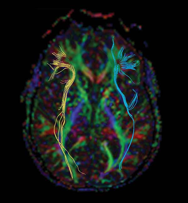 A CGI image of a human brain